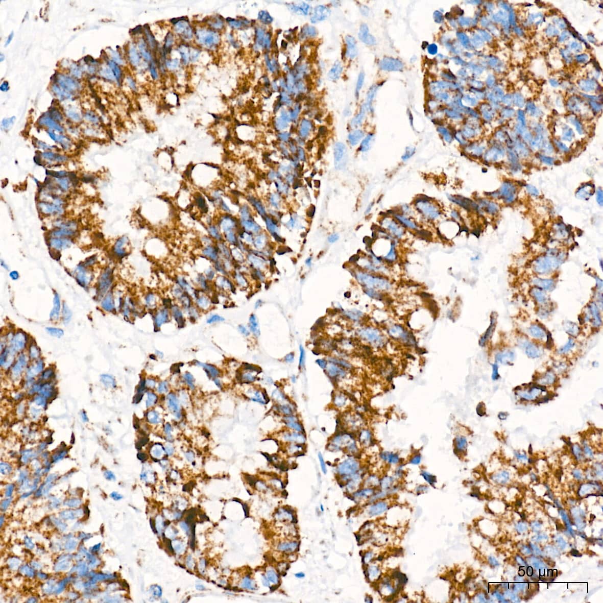 Immunohistochemistry: AIF Antibody (5F0Y1) [AIF] - Immunohistochemistry analysis of paraffin-embedded Human colon carcinoma tissue using AIF Rabbit mAb  at a dilution of 1:500 (40x lens). High pressure antigen retrieval performed with 0.01M Tris-EDTA Buffer (pH 9.0) prior to IHC staining.