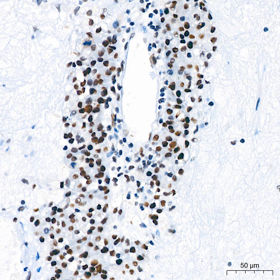 Immunohistochemistry: TCF7L2 Antibody (1W10T6) [TCF7L2] - Immunohistochemistry analysis of paraffin-embedded Human liver cancer tissue using TCF7L2 Rabbit mAb  at a dilution of 1:200 (40x lens). High pressure antigen retrieval performed with 0.01M Tris-EDTA Buffer (pH 9.0) prior to IHC staining.