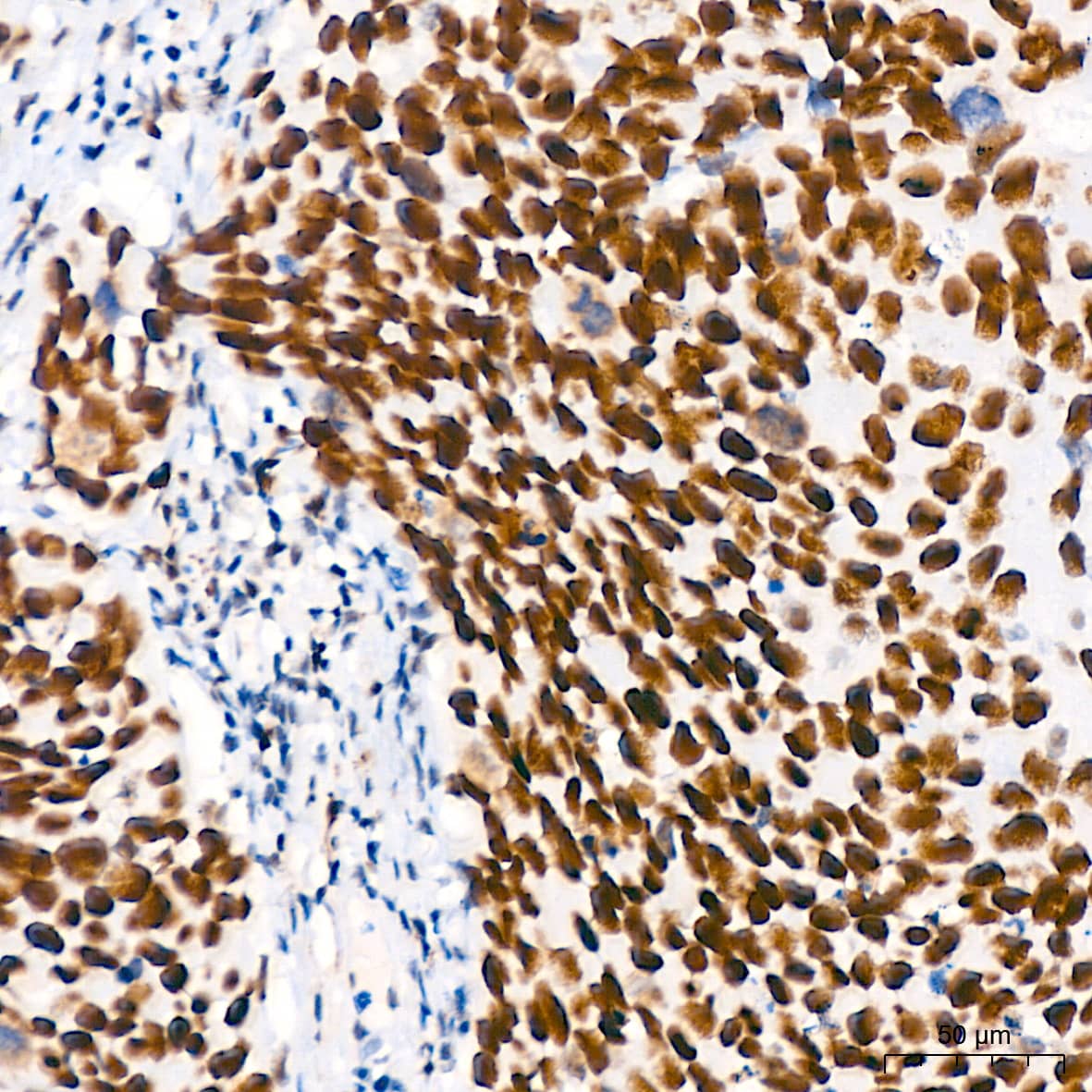 Immunohistochemistry: TCF7L2 Antibody (1W10T6) [TCF7L2] - Immunohistochemistry analysis of paraffin-embedded Human cervix cancer tissue using TCF7L2 Rabbit mAb  at a dilution of 1:200 (40x lens). High pressure antigen retrieval performed with 0.01M Tris-EDTA Buffer (pH 9.0) prior to IHC staining.