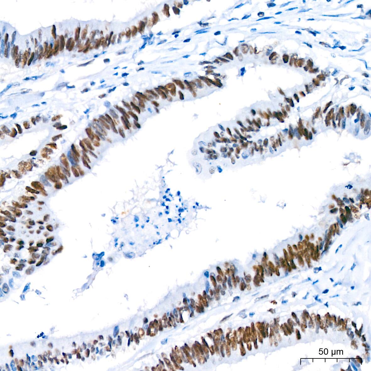 Immunohistochemistry: TCF7L2 Antibody (1W10T6) [TCF7L2] - Immunohistochemistry analysis of paraffin-embedded Human colon carcinoma tissue using TCF7L2 Rabbit mAb  at a dilution of 1:200 (40x lens). High pressure antigen retrieval performed with 0.01M Tris-EDTA Buffer (pH 9.0) prior to IHC staining.