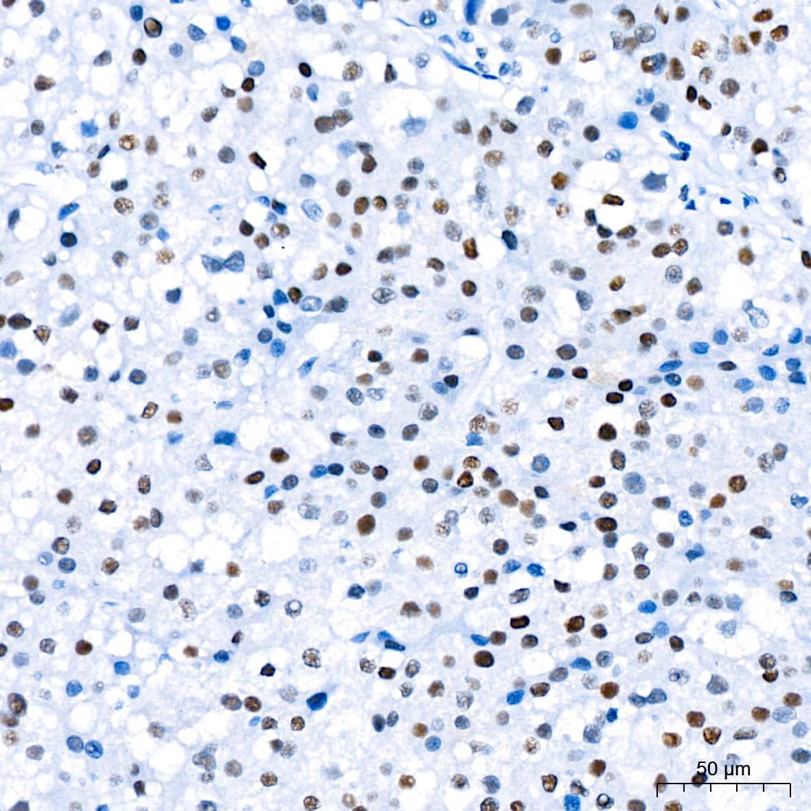 Immunohistochemistry: TCF7L2 Antibody (1W10T6) [TCF7L2] - Immunohistochemistry analysis of paraffin-embedded Human liver tissue using TCF7L2 Rabbit mAb  at a dilution of 1:200 (40x lens). High pressure antigen retrieval performed with 0.01M Citrate Bufferr (pH 6.0) prior to IHC staining.