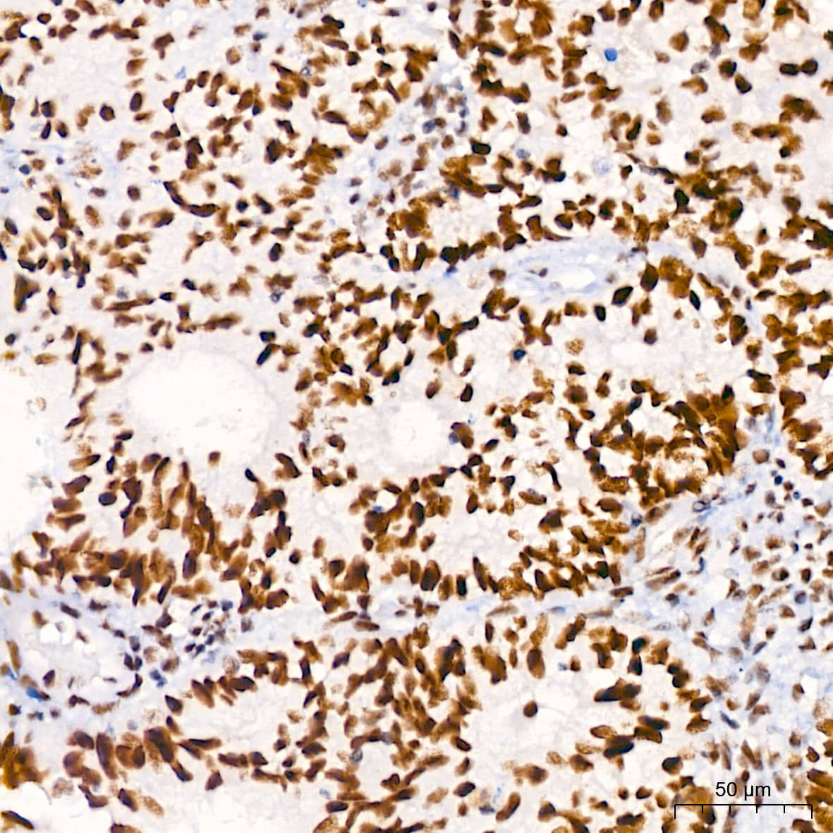 Immunohistochemistry: Brg1 Antibody (4N9C4) [Brg1] - Immunohistochemistry analysis of paraffin-embedded Human endometrium cancer using Brg1 Rabbit mAb  at dilution of 1:100 (40x lens). High pressure antigen retrieval performed with 0.01M Tris/EDTA Buffer (pH 9.0) prior to IHC staining.