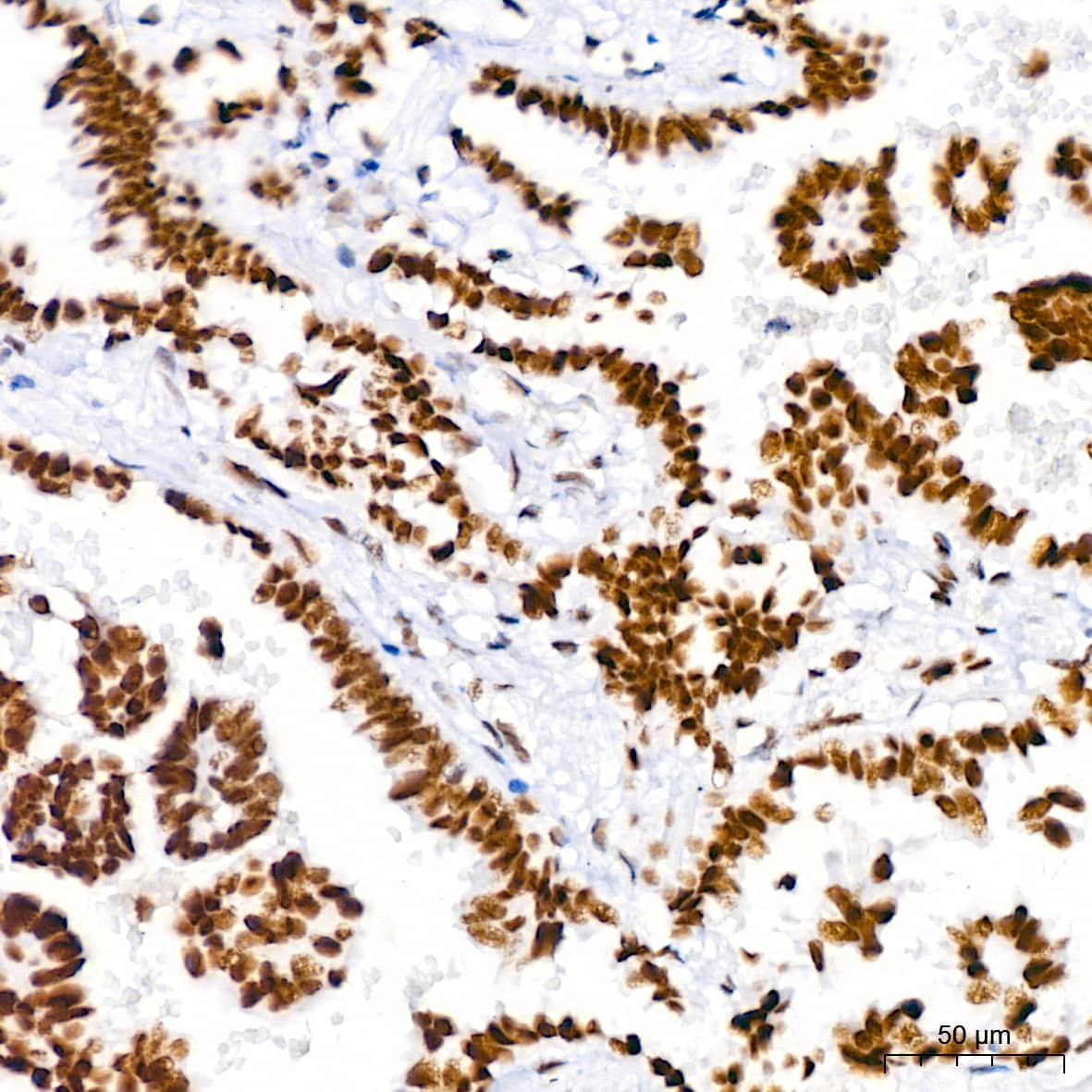 Immunohistochemistry: Brg1 Antibody (4N9C4) [Brg1] - Immunohistochemistry analysis of paraffin-embedded Human lung adenocarcinoma using Brg1 Rabbit mAb  at dilution of 1:100 (40x lens). High pressure antigen retrieval performed with 0.01M Tris/EDTA Buffer (pH 9.0) prior to IHC staining.