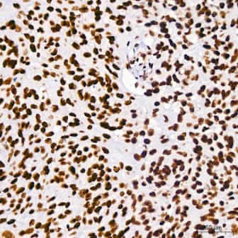 Immunohistochemistry-Paraffin: Brg1 Antibody (4N9C4) [NBP3-15773] - Analysis of paraffin-embedded Human cervix cancer using BRG1/SMARCA4 Rabbit mAb at dilution of 1:100 (40x lens). High pressure antigen retrieval performed with 0.01M Tris/EDTA Buffer (pH 9.0) prior to IHC staining.