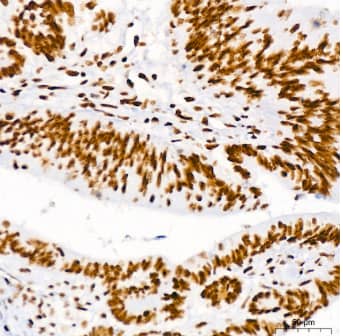 Immunohistochemistry-Paraffin: Brg1 Antibody (4N9C4) [NBP3-15773] -Analysis of paraffin-embedded Human colon carcinoma using BRG1/SMARCA4 Rabbit mAb at dilution of 1:100 (40x lens). High pressure antigen retrieval performed with 0.01M Tris/EDTA Buffer (pH 9.0) prior to IHC staining.