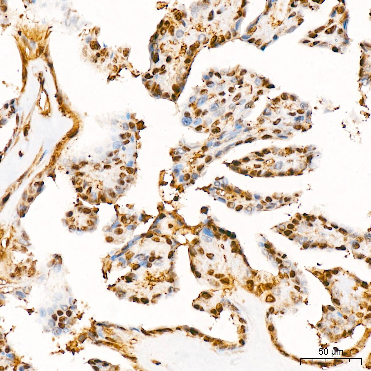 Immunohistochemistry: ERK1 Antibody (0B0C1) [ERK1] - Immunohistochemistry analysis of paraffin-embedded Human thyroid cancer tissue using [KD Validated] ERK1 Rabbit mAb  at a dilution of 1:200 (40x lens). High pressure antigen retrieval was performed with 0.01 M citrate buffer (pH 6.0) prior to IHC staining.