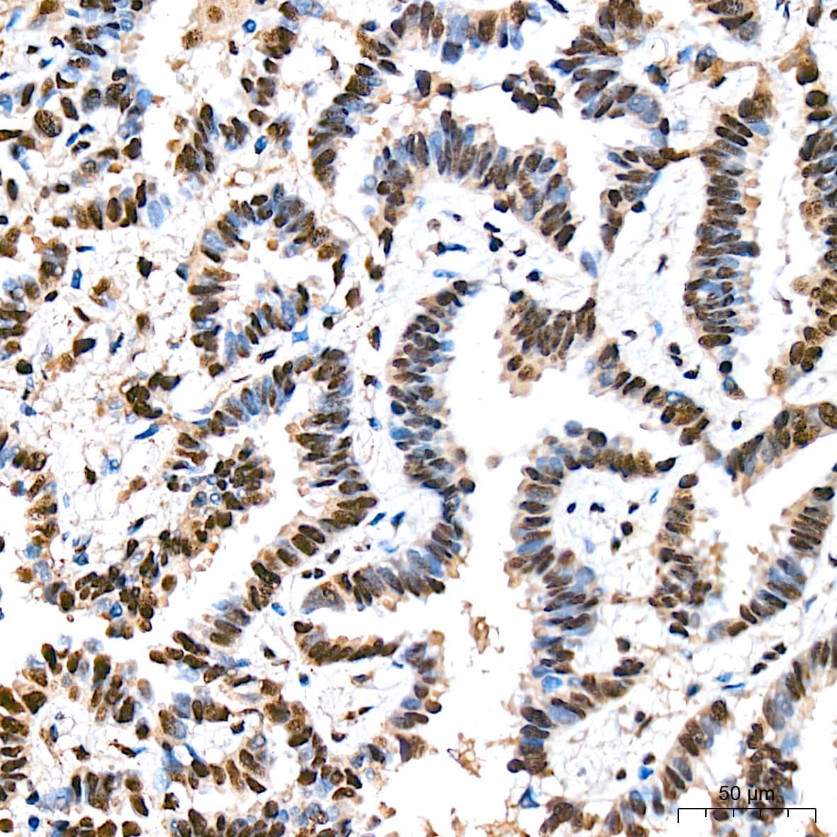 Immunohistochemistry: COP9 Antibody (7V1L8) [COP9] - Immunohistochemistry analysis of paraffin-embedded Human lung cancer tissue using COP9 Rabbit mAb  at a dilution of 1:200 (40x lens). High pressure antigen retrieval was performed with 0.01 M citrate buffer (pH 6.0) prior to IHC staining.