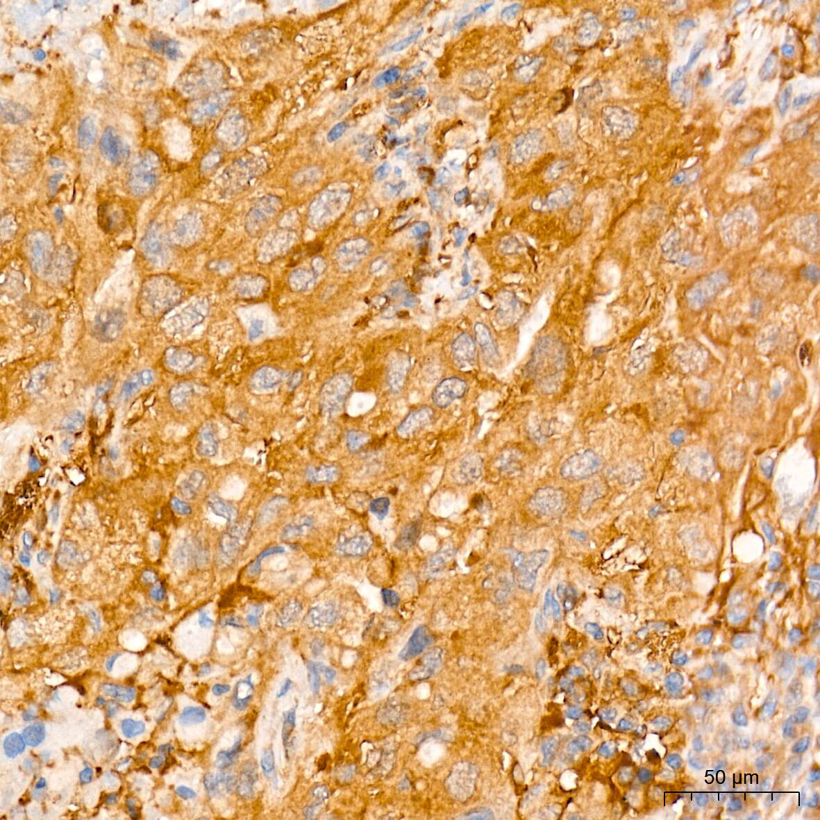 Immunohistochemistry: ATG7 Antibody (3X1W4) [ATG7] - Immunohistochemistry analysis of paraffin-embedded Human lung cancer tissue using [KD Validated] ATG7 Rabbit mAb  at a dilution of 1:500 (40x lens). High pressure antigen retrieval performed with 0.01M Tris-EDTA Buffer (pH 9.0) prior to IHC staining.