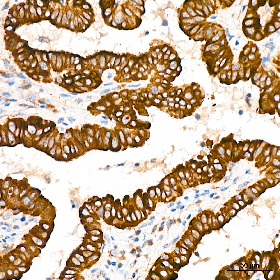 Immunohistochemistry: alpha COP I Antibody (3W6Y6) [NBP3-15839] - Immunohistochemistry analysis of alpha COP I in paraffin-embedded human thyroid cancer tissue using alpha COP I Rabbit mAb  at a dilution of 1:200 (40x lens). High pressure antigen retrieval was performed with 0.01 M citrate buffer (pH 6.0) prior to IHC staining.