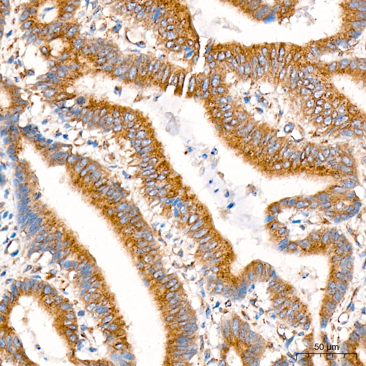 Immunohistochemistry: alpha COP I Antibody (3W6Y6) [NBP3-15839] - Immunohistochemistry analysis of alpha COP I in paraffin-embedded human colon carcinoma tissue using alpha COP I Rabbit mAb  at a dilution of 1:200 (40x lens). High pressure antigen retrieval was performed with 0.01 M citrate buffer (pH 6.0) prior to IHC staining.
