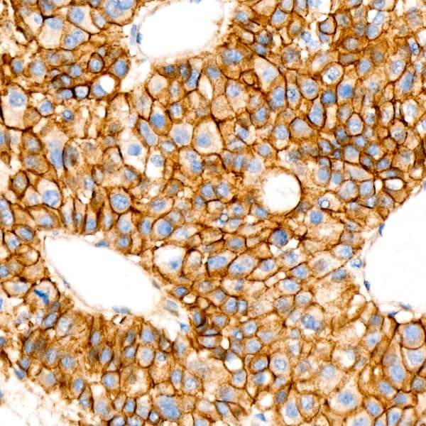 Immunohistochemistry: beta-Catenin Antibody (6A3P2) [beta-Catenin] - Immunohistochemistry analysis of paraffin-embedded Human liver cancer using [KO Validated] beta-Catenin Rabbit mAb  at dilution of 1:100 (40x lens). High pressure antigen retrieval performed with 0.01M Citrate Bufferr (pH 6.0) prior to IHC staining.