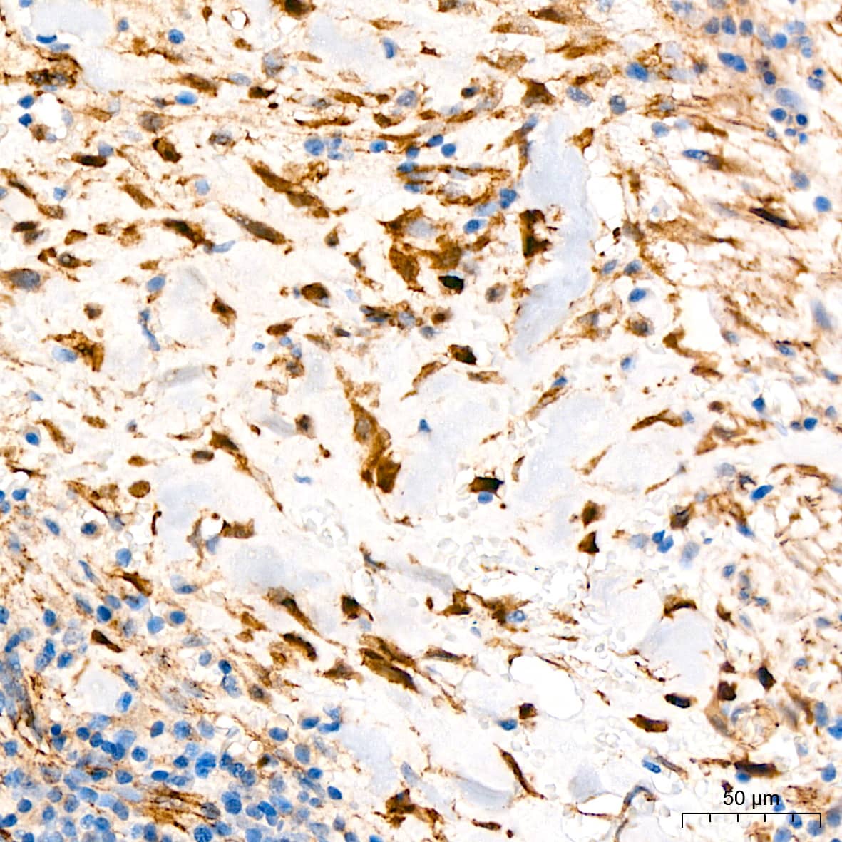 Immunohistochemistry: beta-Catenin Antibody (6A3P2) [beta-Catenin] - Immunohistochemistry analysis of paraffin-embedded Human solitary fibrous tumor tissue using [KO Validated] beta-Catenin Rabbit mAb  at a dilution of  1:200 (40x lens). High pressure antigen retrieval was performed with 0.01 M Tris-EDTA buffer (pH 9.0) prior to IHC staining.