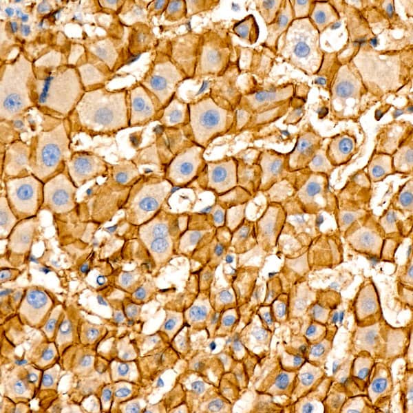 Immunohistochemistry: beta-Catenin Antibody (6A3P2) [beta-Catenin] - Immunohistochemistry analysis of paraffin-embedded Human liver using [KO Validated] beta-Catenin Rabbit mAb  at dilution of 1:100 (40x lens). High pressure antigen retrieval performed with 0.01M Citrate Bufferr (pH 6.0) prior to IHC staining.