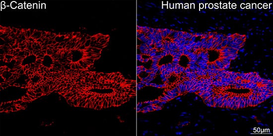 Immunocytochemistry/ Immunofluorescence: beta-Catenin Antibody (6A3P2) [beta-Catenin] - Confocal imaging of paraffin-embedded Human prostate cancer tissue using [KO Validated] beta-Catenin Rabbit mAb  followed by a further incubation with Cy3 Goat Anti-Rabbit IgG (H+L)  . DAPI was used for nuclear staining (Blue). High pressure antigen retrieval performed with 0.01M Citrate Buffer (pH 6.0) prior to IF staining. Objective: 40x.