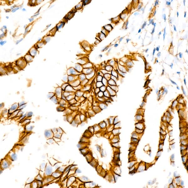 Immunohistochemistry: beta-Catenin Antibody (6A3P2) [beta-Catenin] - Immunohistochemistry analysis of paraffin-embedded Human thyroid cancer using [KO Validated] beta-Catenin Rabbit mAb  at dilution of 1:100 (40x lens). High pressure antigen retrieval performed with 0.01M Citrate Bufferr (pH 6.0) prior to IHC staining.