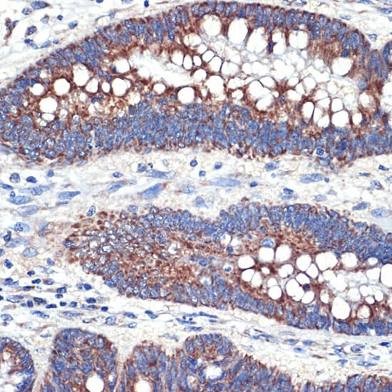 Immunohistochemistry: TTC11 Antibody (6S1G4) [TTC11] - Immunohistochemistry analysis of paraffin-embedded Human colon carcinoma tissue using [KO Validated] TTC11 Rabbit mAb  at a dilution of 1:100 (40x lens). Microwave antigen retrieval performed with 0.01M Tris-EDTA Buffer (pH 9.0) prior to IHC staining.