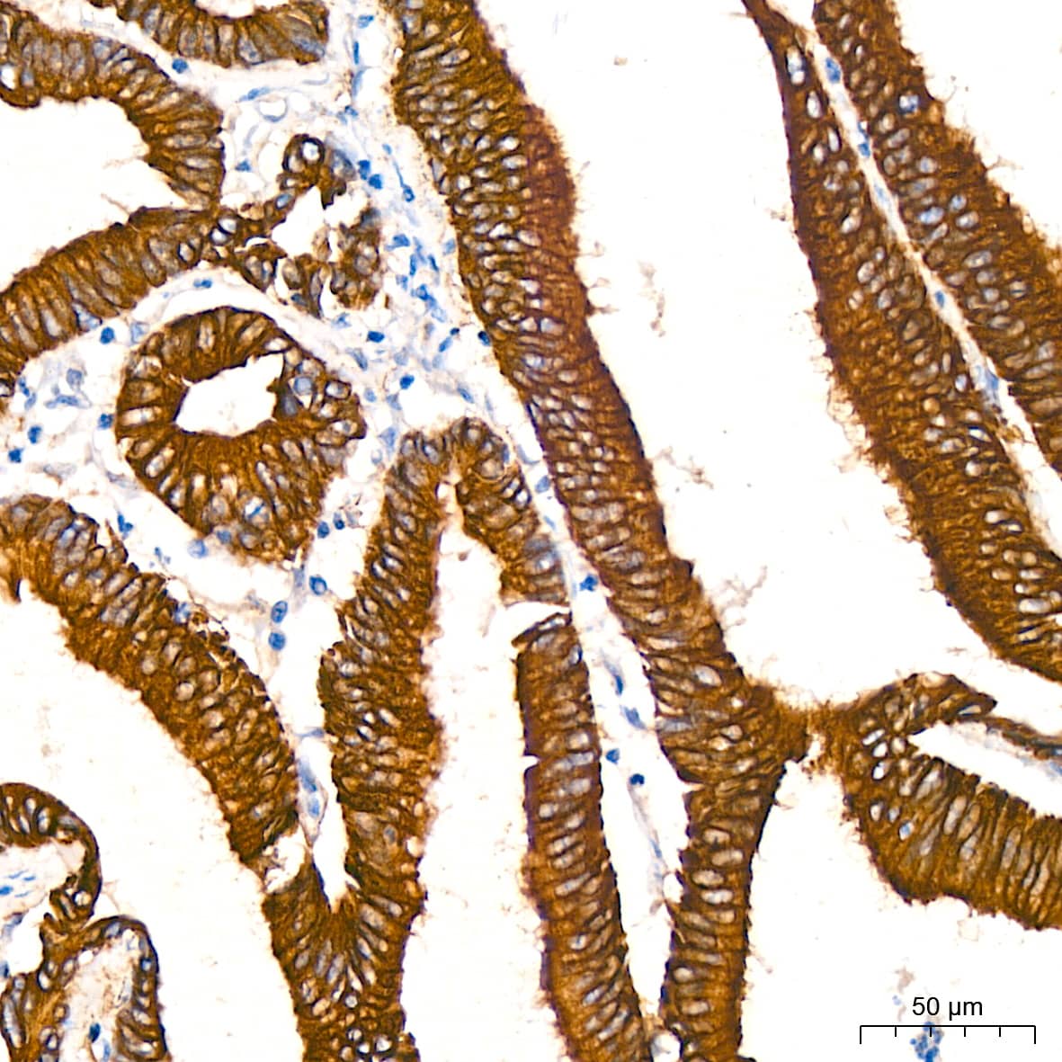 Immunohistochemistry: ATG5 Antibody (8L7X6) [ATG5] - Immunohistochemistry analysis of paraffin-embedded Human colon carcinoma tissue using [KO Validated] ATG5 Rabbit mAb  at a dilution of 1:200 (40x lens). High pressure antigen retrieval performed with 0.01M Citrate Buffer (pH 6.0) prior to IHC staining.