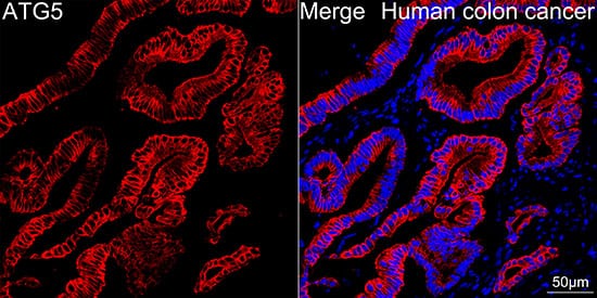 Immunocytochemistry/ Immunofluorescence: ATG5 Antibody (8L7X6) [ATG5] - Confocal imaging of paraffin-embedded Human colon cancer tissue using [KO Validated] ATG5 Rabbit mAb  followed by a further incubation with Cy3 Goat Anti-Rabbit IgG (H+L)  . DAPI was used for nuclear staining (Blue). High pressure antigen retrieval performed with 0.01M Citrate Buffer (pH 6.0) prior to IF staining. Objective: 40x.