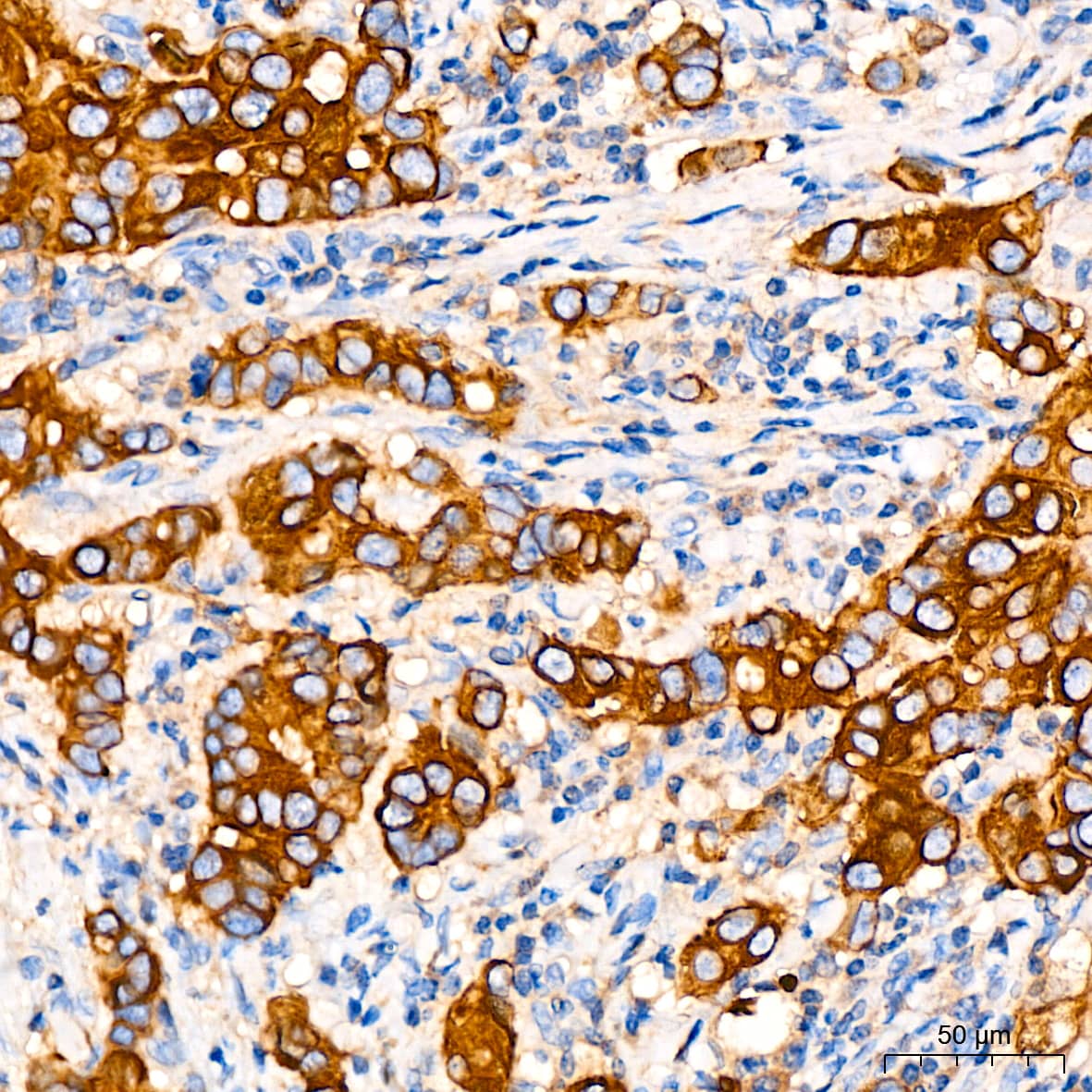 Immunohistochemistry: ATG5 Antibody (8L7X6) [ATG5] - Immunohistochemistry analysis of paraffin-embedded Human breast cancer tissue using [KO Validated] ATG5 Rabbit mAb  at a dilution of 1:200 (40x lens). High pressure antigen retrieval performed with 0.01M Citrate Buffer (pH 6.0) prior to IHC staining.