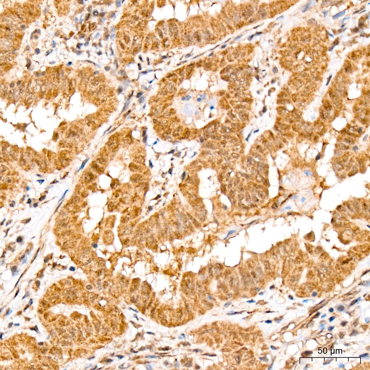 Immunohistochemistry: HspA4 Antibody (10A9C5) [HspA4] - Immunohistochemistry analysis of HspA4 in paraffin-embedded human thyroid cancer tissue using HspA4 Rabbit mAb  at a dilution of 1:200 (40x lens). High pressure antigen retrieval was performed with 0.01 M citrate buffer (pH 6.0) prior to IHC staining.