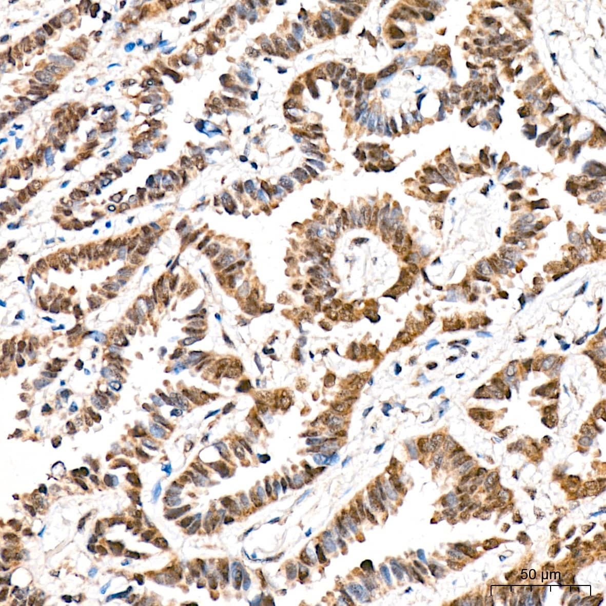 Immunohistochemistry: HspA4 Antibody (10A9C5) [HspA4] - Immunohistochemistry analysis of HspA4 in paraffin-embedded Human lung adenocarcinoma tissue using HspA4 Rabbit mAb  at a dilution of 1:200 (40x lens). High pressure antigen retrieval was performed with 0.01 M citrate buffer (pH 6.0) prior to IHC staining.