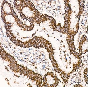 Immunohistochemistry-Paraffin: VDAC1 Antibody (6B1K1) [NBP3-15871] - Human colon carcinoma tissue using VDAC1 Rabbit mAb at a dilution of 1:200 (40x lens). High pressure antigen retrieval was performed with 0.01 M citrate buffer (pH 6.0) prior to IHC staining.