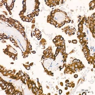 Immunohistochemistry-Paraffin: VDAC1 Antibody (6B1K1) [NBP3-15871] -Human thyroid cancer tissue using VDAC1 Rabbit mAb  at a dilution of 1:200 (40x lens). High pressure antigen retrieval was performed with 0.01 M citrate buffer (pH 6.0) prior to IHC staining.