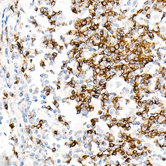 Immunohistochemistry: IGHD Antibody (5M8U3) [IGHD] - Immunohistochemistry analysis of paraffin-embedded Human Hodgkin lymphoma using IGHD Rabbit mAb  at dilution of 1:100 (40x lens). High pressure antigen retrieval performed with 0.01M Tris/EDTA Buffer (pH 9.0) prior to IHC staining.