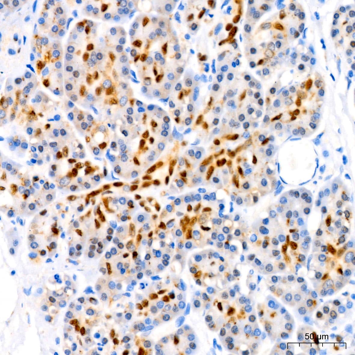 Immunohistochemistry: SOX9 Antibody (5Y4J8) [SOX9] - Immunohistochemistry analysis of paraffin-embedded Human pancreas using SOX9 Rabbit mAb  at dilution of 1:400 (40x lens). High pressure antigen retrieval performed with 0.01M Tris/EDTA Buffer (pH 9.0) prior to IHC staining.