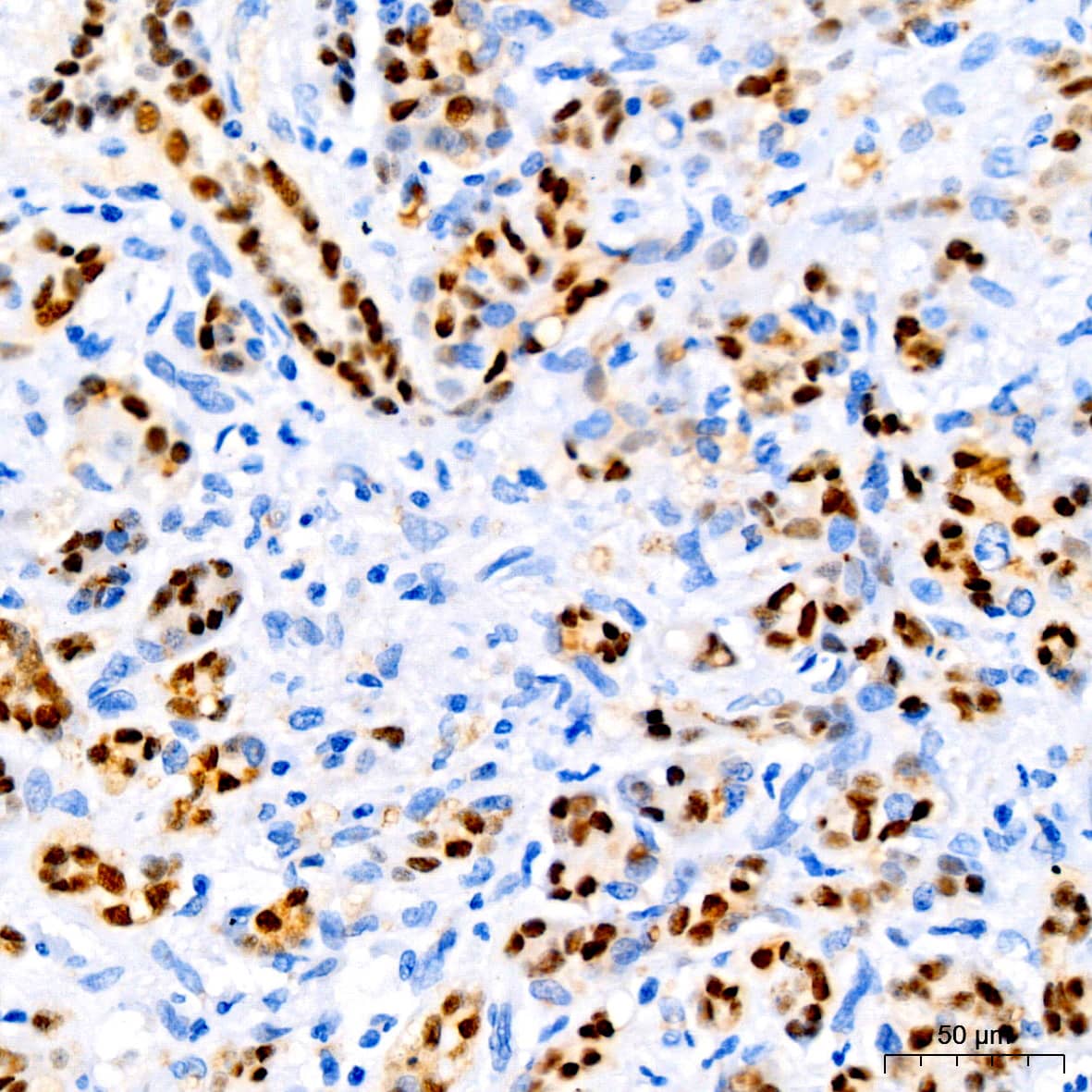 Immunohistochemistry: SOX9 Antibody (5Y4J8) [SOX9] - Immunohistochemistry analysis of paraffin-embedded Human pancreatic ductal carcinoma using SOX9 Rabbit mAb  at dilution of 1:400 (40x lens). High pressure antigen retrieval performed with 0.01M Tris/EDTA Buffer (pH 9.0) prior to IHC staining.