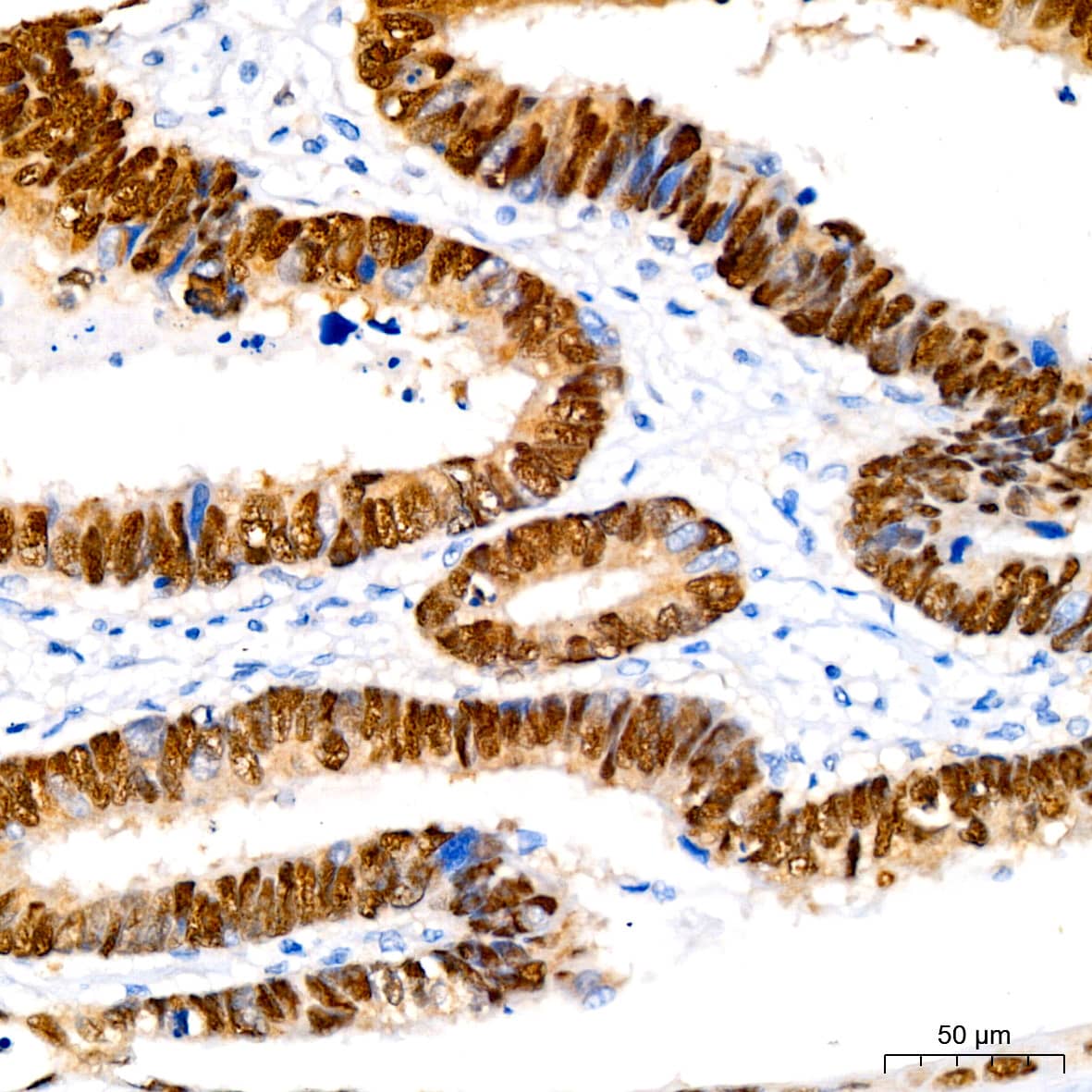 Immunohistochemistry: SOX9 Antibody (5Y4J8) [SOX9] - Immunohistochemistry analysis of paraffin-embedded Human gastric cancer using SOX9 Rabbit mAb  at dilution of 1:400 (40x lens). High pressure antigen retrieval performed with 0.01M Tris/EDTA Buffer (pH 9.0) prior to IHC staining.