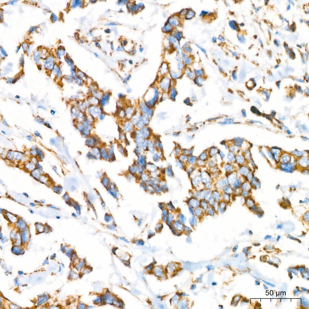 Immunohistochemistry: NDUFB8 Antibody (6T8G1) [NDUFB8] - Immunohistochemistry analysis of paraffin-embedded Human breast cancer using NDUFB8 Rabbit mAb  at dilution of 1:200 (40x lens). High pressure antigen retrieval performed with 0.01M Citrate Bufferr (pH 6.0) prior to IHC staining.