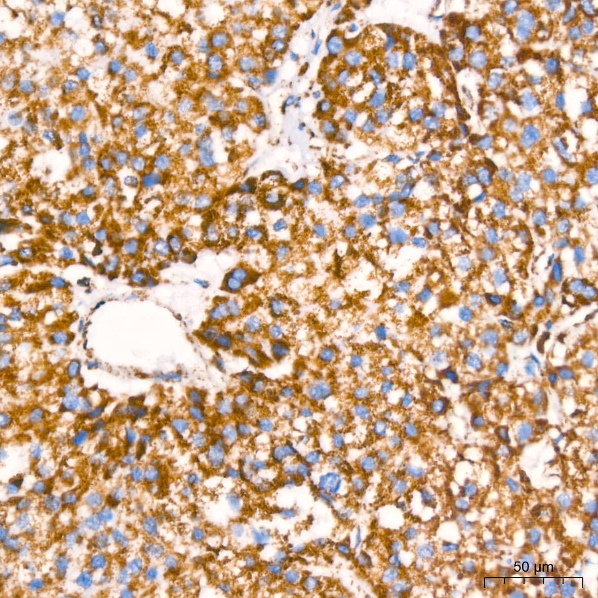 Immunohistochemistry: NDUFB8 Antibody (6T8G1) [NDUFB8] - Immunohistochemistry analysis of paraffin-embedded Human liver cancer using NDUFB8 Rabbit mAb  at dilution of 1:200 (40x lens). High pressure antigen retrieval performed with 0.01M Citrate Bufferr (pH 6.0) prior to IHC staining.