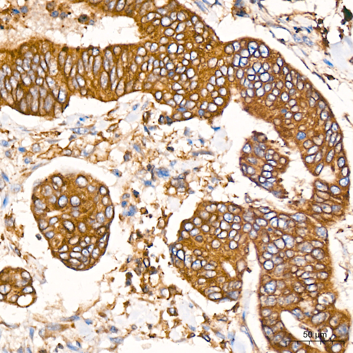 Immunohistochemistry: ERP29 Antibody (1J0D3) [ERP29] - Immunohistochemistry analysis of ERP29 in paraffin-embedded human colon carcinoma tissue using ERP29 Rabbit mAb  at a dilution of 1:1000 (40x lens). High pressure antigen retrieval was performed with 0.01 M citrate buffer (pH 6.0) prior to IHC staining.