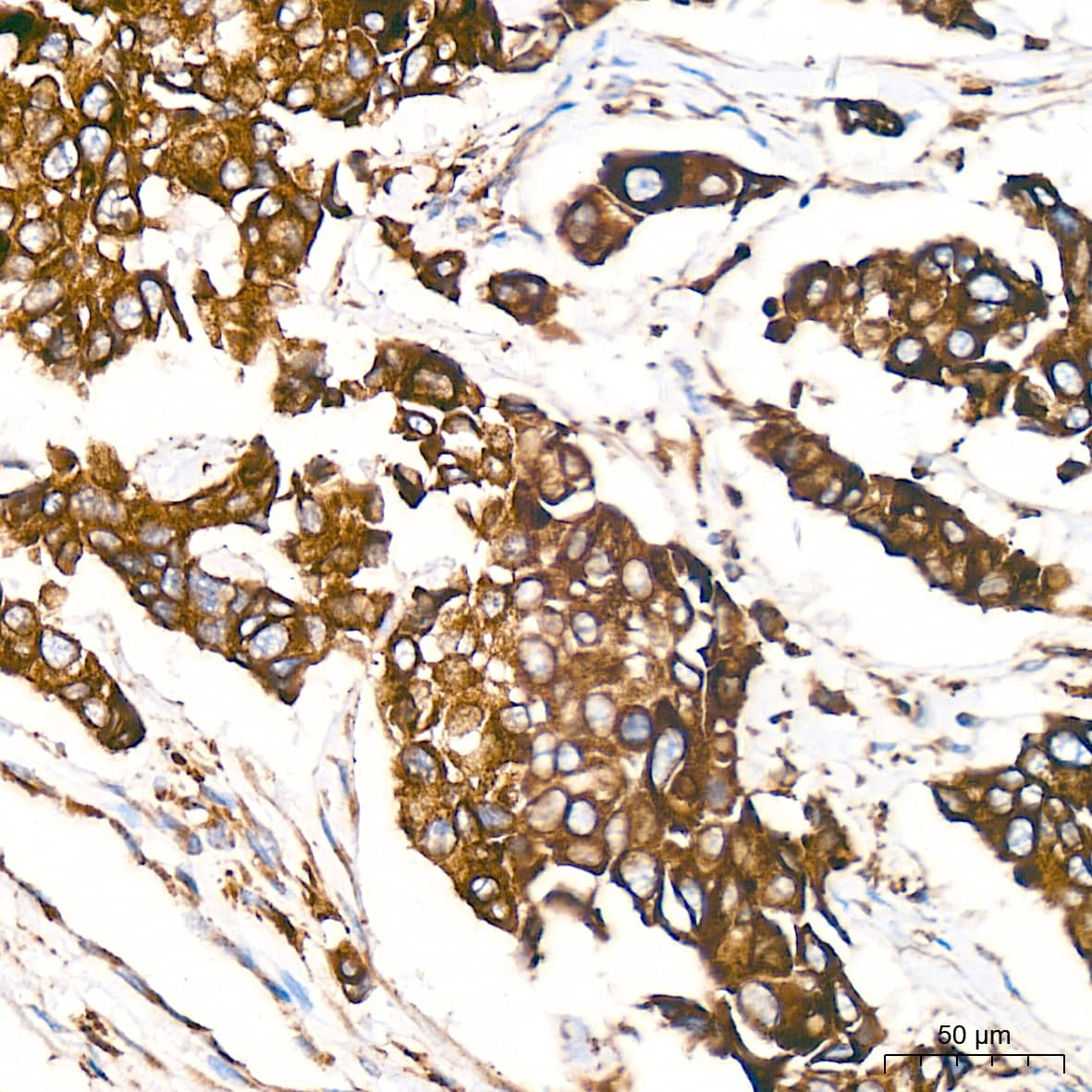 Immunohistochemistry: ERP29 Antibody (1J0D3) [NBP3-15906] - Immunohistochemistry analysis of ERP29 in paraffin-embedded human breast cancer tissue using ERP29 Rabbit mAb  at a dilution of 1:1000 (40x lens). High pressure antigen retrieval was performed with 0.01 M citrate buffer (pH 6.0) prior to IHC staining.