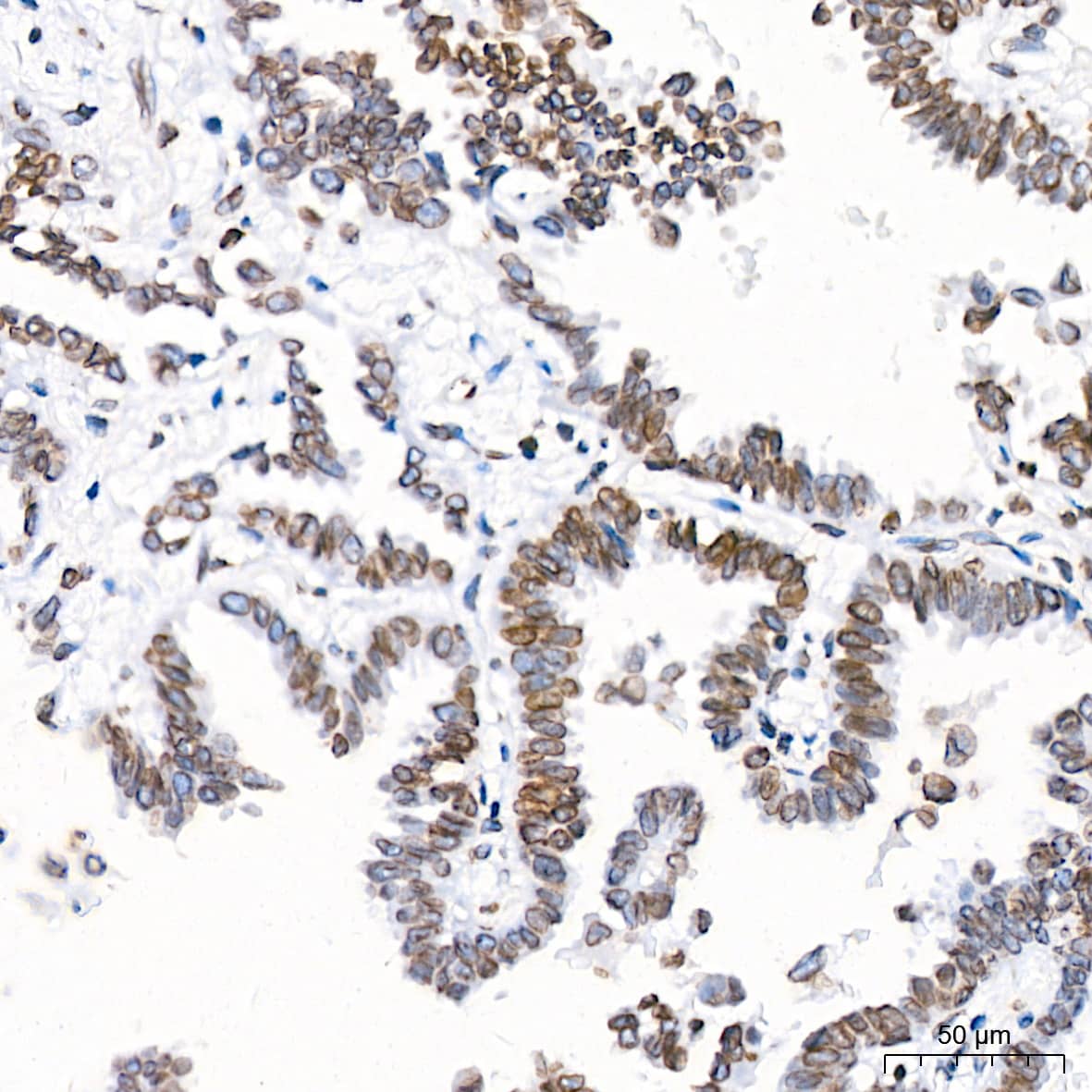 Immunohistochemistry: UNC84B Antibody (8E8D7) [NBP3-15912] - Immunohistochemistry analysis of UNC84B in paraffin-embedded Human lung adenocarcinoma tissue using UNC84B Rabbit mAb  at a dilution of 1:200 (40x lens).High pressure antigen retrieval was performed with 0.01 M citrate buffer (pH 6.0) prior to IHC staining.