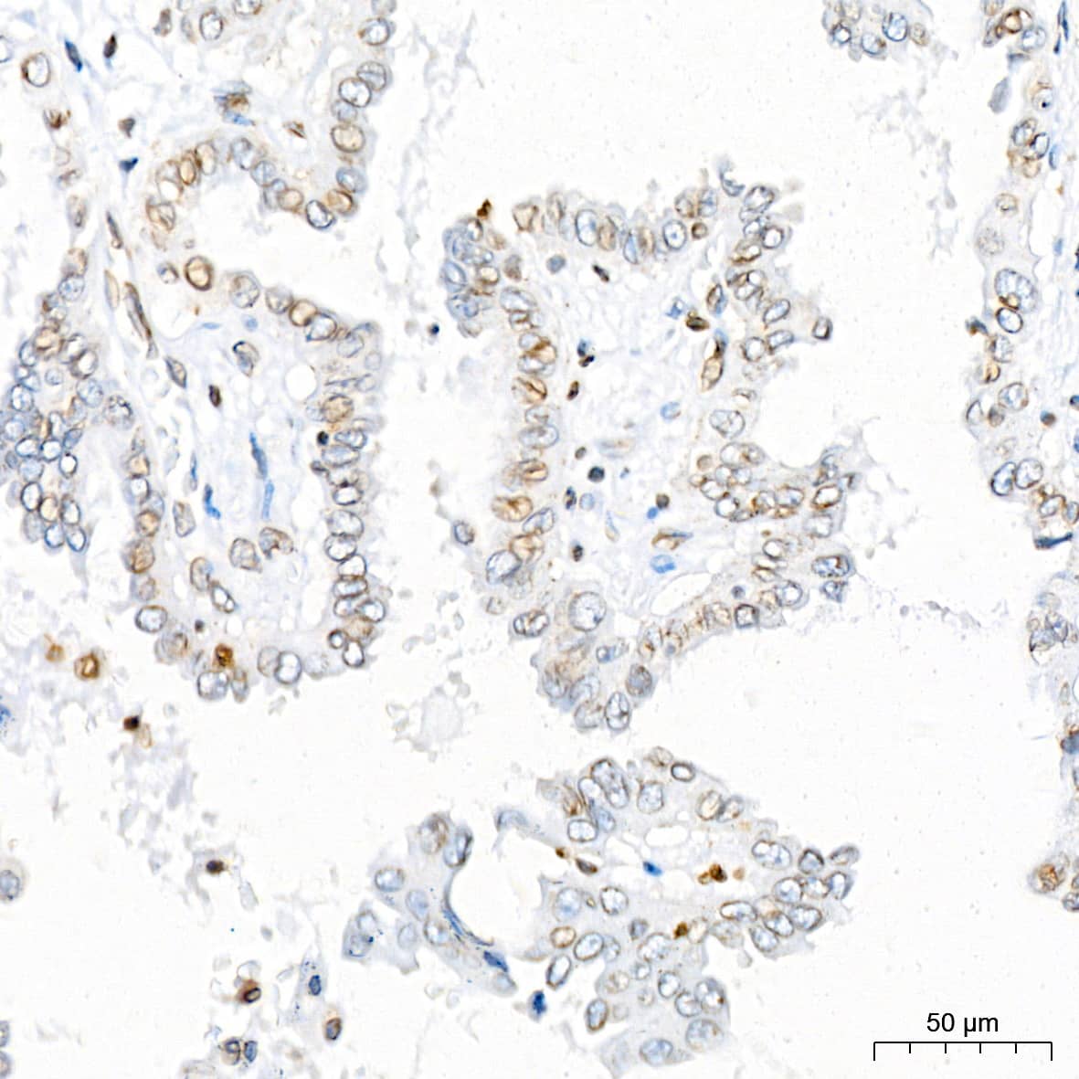 Immunohistochemistry: UNC84B Antibody (8E8D7) [NBP3-15912] - Immunohistochemistry analysis of UNC84B in paraffin-embedded human thyroid cancer tissue using UNC84B Rabbit mAb  at a dilution of 1:200 (40x lens).High pressure antigen retrieval was performed with 0.01 M citrate buffer (pH 6.0) prior to IHC staining.