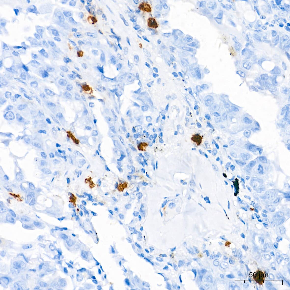 Immunohistochemistry: Tryptase beta-2/TPSB2 Antibody (6U1C5) [NBP3-15925] - Immunohistochemistry analysis of paraffin-embedded Human lung cancer tissue using Tryptase beta-2/TPSB2 Rabbit mAb  at a dilution of 1:40000 (40x lens). High pressure antigen retrieval performed with 0.01M Tris-EDTA Buffer (pH 9.0) prior to IHC staining.