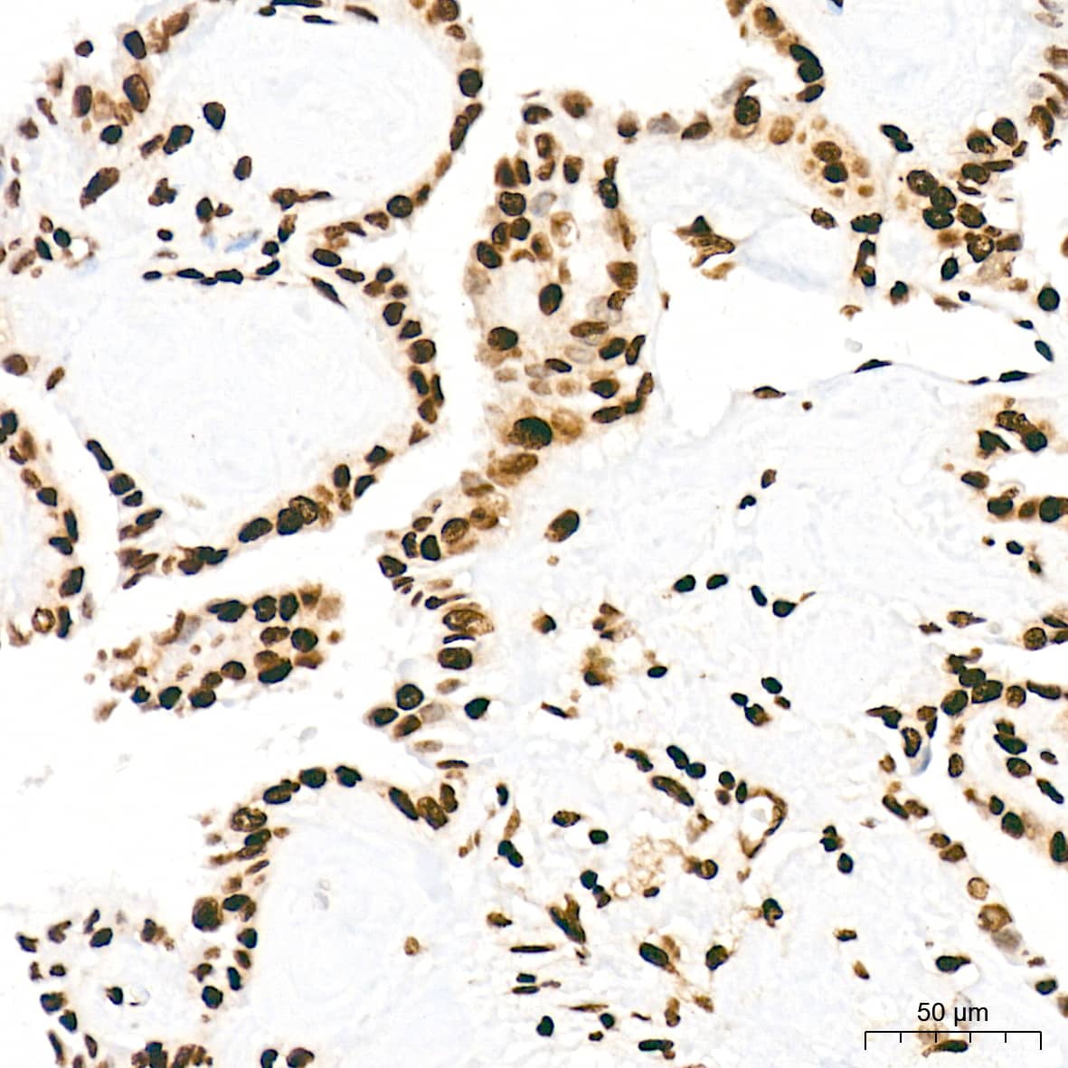 Immunohistochemistry: Histone H3 [ac Lys27] Antibody (2V10N10) [Histone H3] - Immunohistochemistry analysis of paraffin-embedded Human thyroid cancer tissue using Histone H3 Rabbit mAb  at a dilution of 1:1000 (40x lens). High pressure antigen retrieval was performed with 0.01 M citrate buffer (pH 6.0) prior to IHC staining.