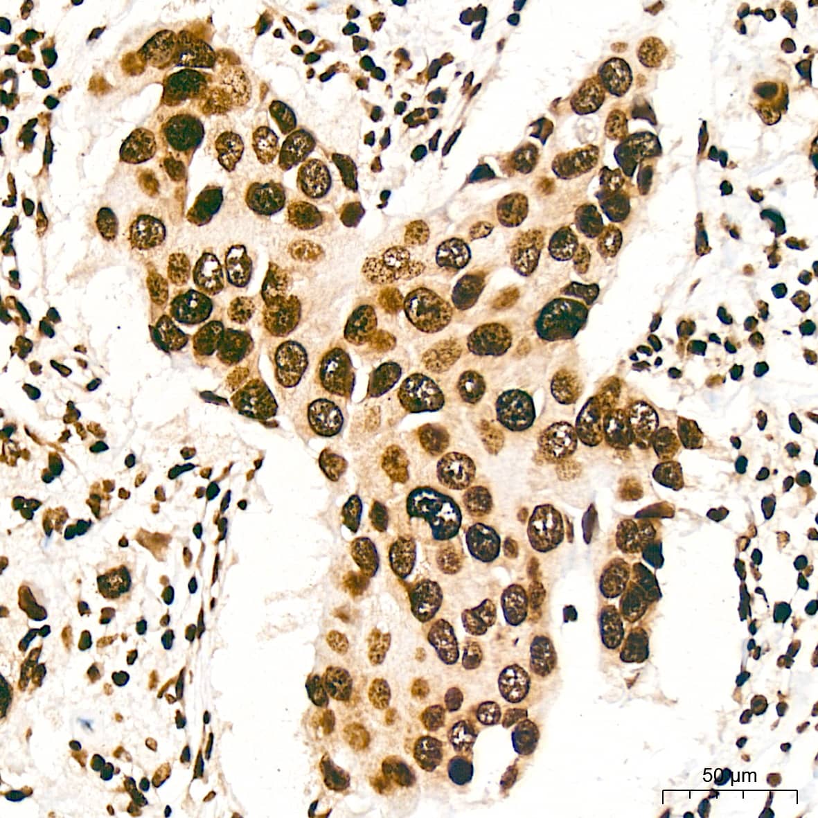 Immunohistochemistry: Histone H3 [ac Lys27] Antibody (2V10N10) [Histone H3] - Immunohistochemistry analysis of paraffin-embedded Human breast cancer tissue using Histone H3 Rabbit mAb  at a dilution of 1:1000 (40x lens). High pressure antigen retrieval was performed with 0.01 M citrate buffer (pH 6.0) prior to IHC staining.