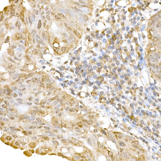 Immunohistochemistry: RNF126 Antibody - Azide and BSA Free [RNF126] - Immunohistochemistry analysis of paraffin-embedded human colon carcinoma using RNF126 Rabbit pAb  at dilution of 1:250 (40x lens).Perform high pressure antigen retrieval with 10 mM citrate buffer pH 6.0 before commencing with IHC staining protocol.