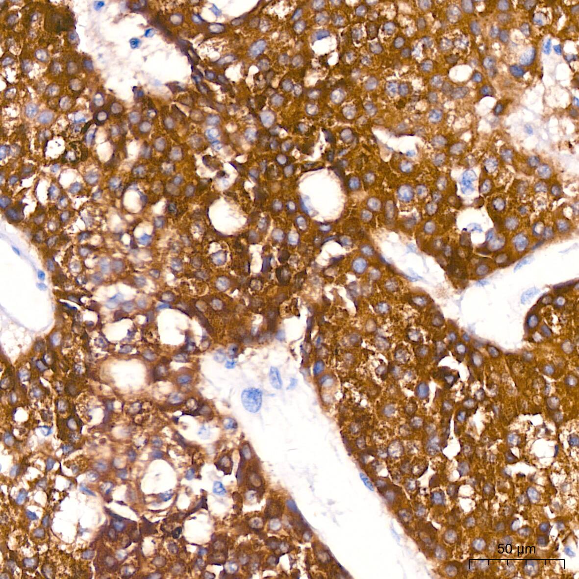 Immunohistochemistry: FACL4 Antibody (4W3T9) [FACL4] - Immunohistochemistry analysis of paraffin-embedded Human liver cancer using FACL4 Rabbit mAb  at dilution of 1:200 (40x lens). High pressure antigen retrieval performed with 0.01M Citrate Bufferr (pH 6.0) prior to IHC staining.