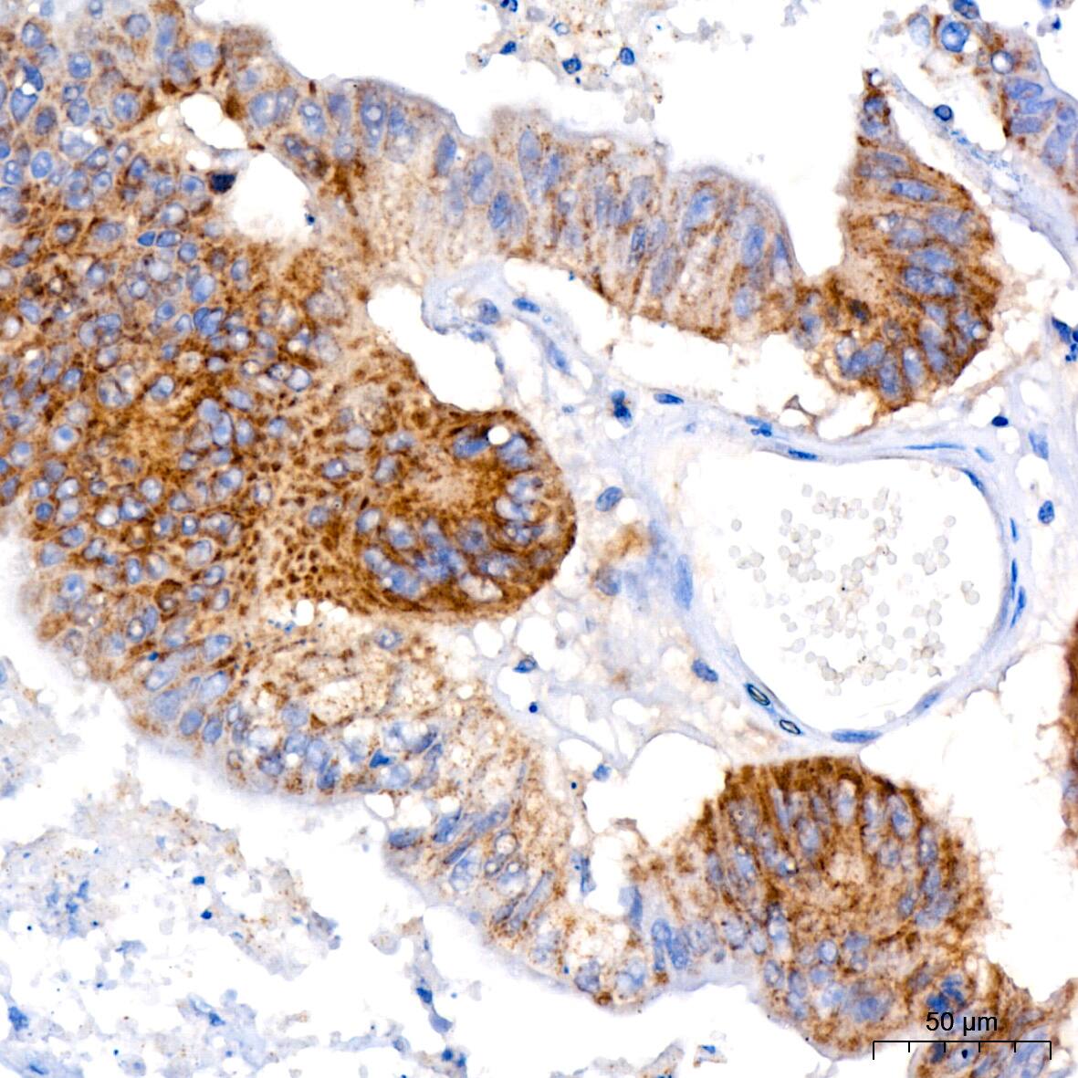 Immunohistochemistry: FACL4 Antibody (4W3T9) [FACL4] - Immunohistochemistry analysis of paraffin-embedded Human colon carcinoma using FACL4 Rabbit mAb  at dilution of 1:200 (40x lens). High pressure antigen retrieval performed with 0.01M Citrate Bufferr (pH 6.0) prior to IHC staining.