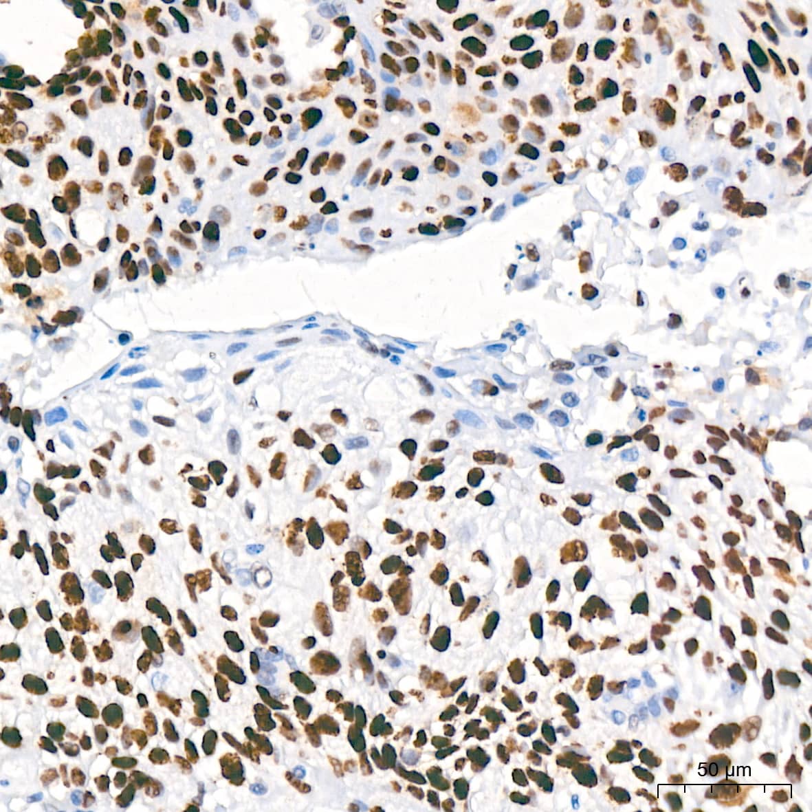 Immunohistochemistry: MCM2 Antibody (0Q10S9) [NBP3-16066] - Immunohistochemistry analysis of paraffin-embedded Human cervix cancer tissue using MCM2 Rabbit mAb at a dilution of 1:200 (40x lens). High pressure antigen retrieval performed with 0.01M Citrate Bufferr (pH 6.0) prior to IHC staining.