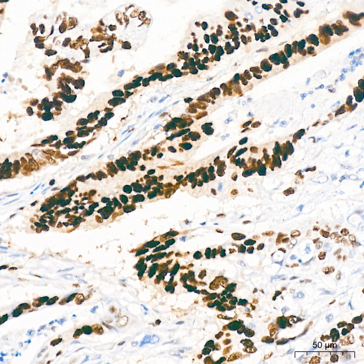 Immunohistochemistry: MCM2 Antibody (0Q10S9) [NBP3-16066] - Immunohistochemistry analysis of paraffin-embedded Human colon carcinoma tissue using MCM2 Rabbit mAb at a dilution of 1:200 (40x lens). High pressure antigen retrieval performed with 0.01M Citrate Bufferr (pH 6.0) prior to IHC staining.