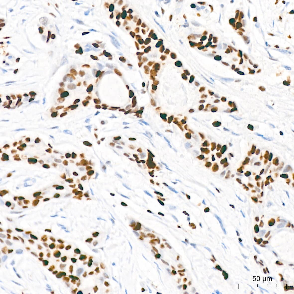 Immunohistochemistry: MCM2 Antibody (0Q10S9) [NBP3-16066] - Immunohistochemistry analysis of paraffin-embedded Human breast cancer tissue using MCM2 Rabbit mAb at a dilution of 1:200 (40x lens). High pressure antigen retrieval performed with 0.01M Citrate Bufferr (pH 6.0) prior to IHC staining.