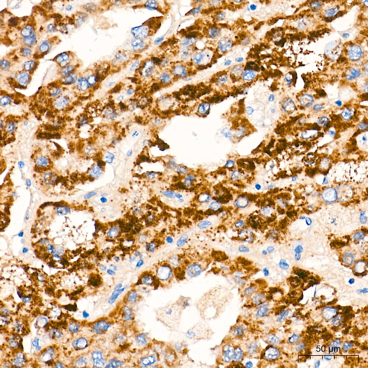 Immunohistochemistry: alpha-Methylacyl-CoA Racemase/AMACR Antibody (7X5Z2) [NBP3-16091] - Immunohistochemistry analysis of paraffin-embedded Human liver cancer tissue using alpha-Methylacyl-CoA Racemase/AMACR Rabbit mAb at a dilution of 1:2000 (40x lens). High pressure antigen retrieval performed with 0.01M Tris-EDTA Buffer (pH 9.0) prior to IHC staining.
