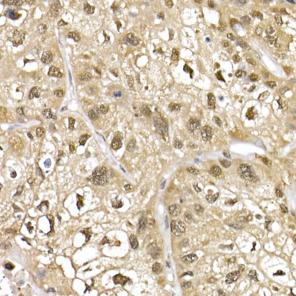 Immunohistochemistry: Cullin 1 Antibody - Azide and BSA Free [NBP3-16092] - Immunohistochemistry analysis of paraffin-embedded Human lung cancer using Cullin 1 Rabbit pAb at dilution of 1:50 (40x lens). High pressure antigen retrieval performed with 0.01M Citrate Bufferr (pH 6.0) prior to IHC staining.