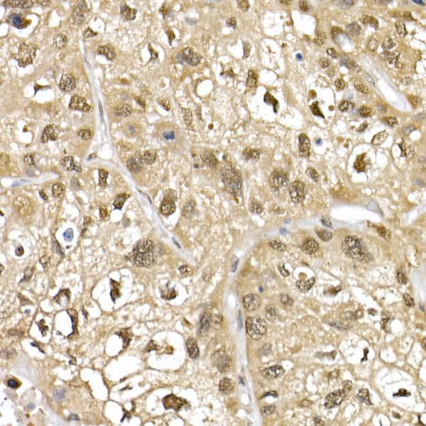 Immunohistochemistry: Cullin 1 Antibody - Azide and BSA Free [Cullin 1] - Immunohistochemistry analysis of paraffin-embedded Human lung cancer using Cullin 1 Rabbit pAb  at dilution of 1:50 (40x lens). High pressure antigen retrieval performed with 0.01M Citrate Bufferr (pH 6.0) prior to IHC staining.