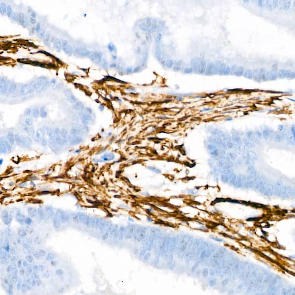 Immunohistochemistry: Actin Antibody (3U6B8) [NBP3-16100] - Immunohistochemistry analysis of paraffin-embedded Human colon carcinoma using alpha-Actin-1 Rabbit mAb at dilution of 1:100 (40x lens). Microwave antigen retrieval performed with 0.01M Tris/EDTA Buffer (pH 9.0) prior to IHC staining.